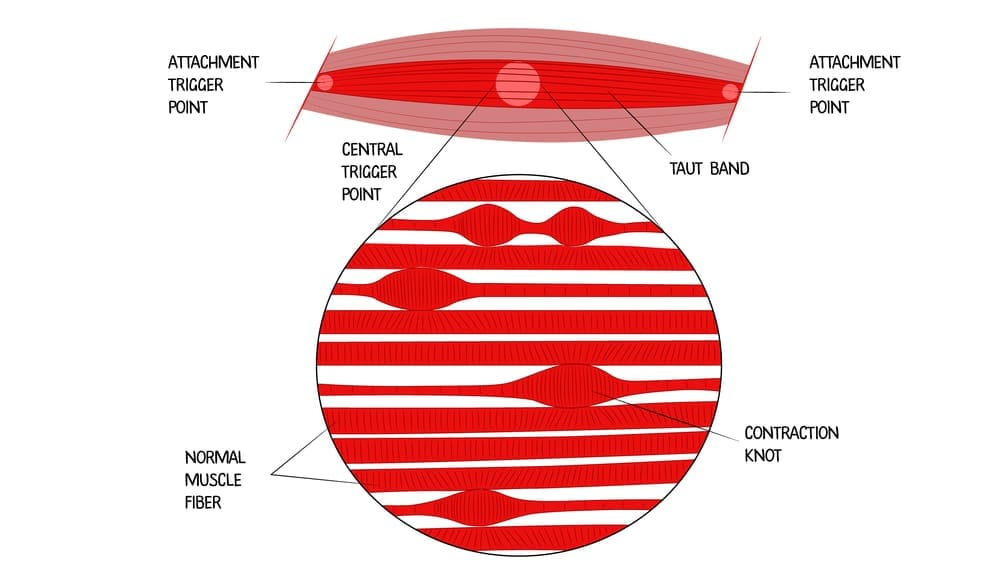 Wat is dry needling behandeling