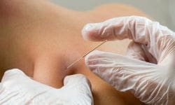 Wat is dry needling fysio
