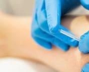 wat is dryneedling