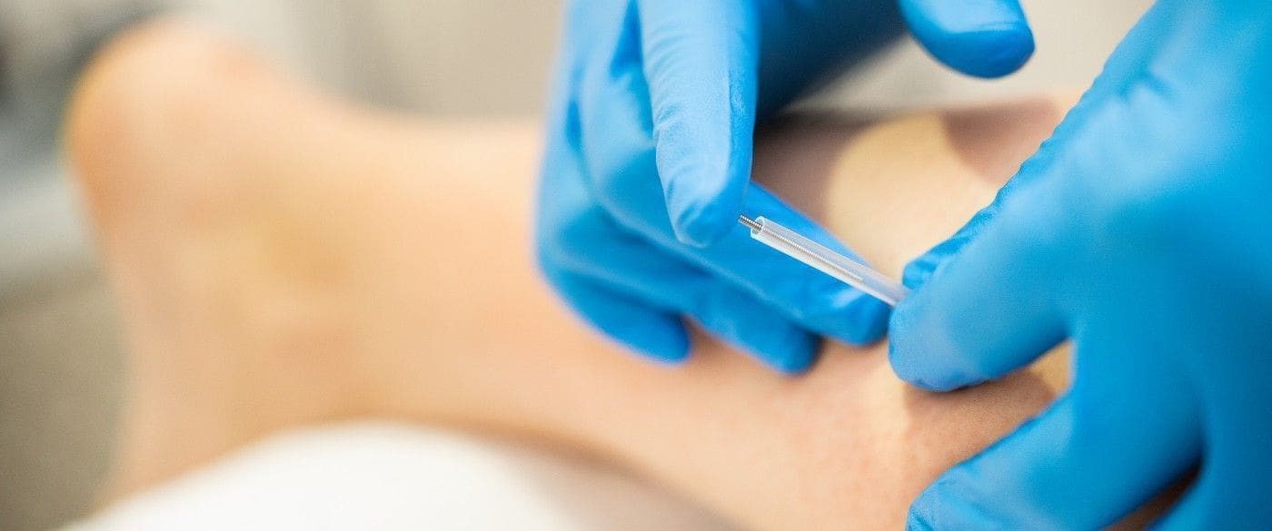 wat is dryneedling